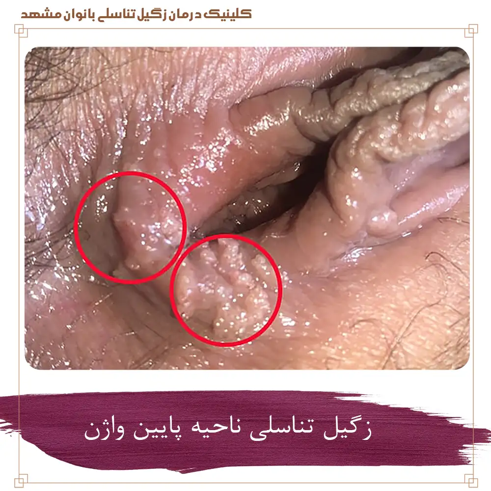 زگیل تناسلی ناحیه پایین واژن
