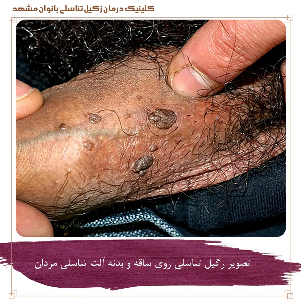 تصویر زگیل تناسلی روی ساقه و بدنه آلت تناسلی مردان