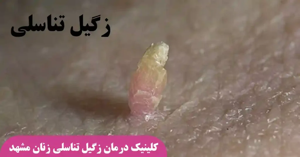 تصویر واضج از یک زگیل تناسلی
