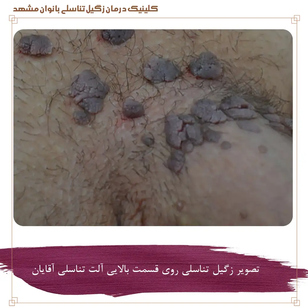 تصویر زگیل تناسلی روی قسمت بالایی آلت تناسلی آقایان