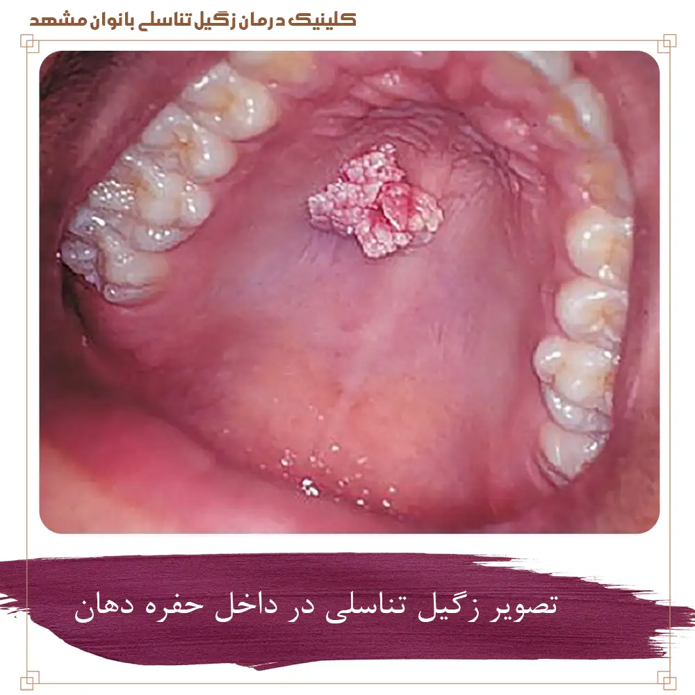 تصویر زگیل تناسلی در داخل حفره دهان