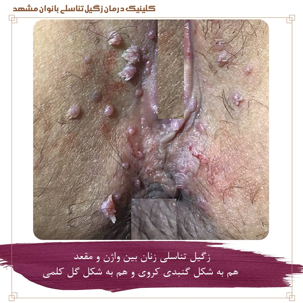تصویر زگیل تناسلی زنان بین واژن و مقعد هم به شکل گنبدی کروی و هم به شکل گل کلمی