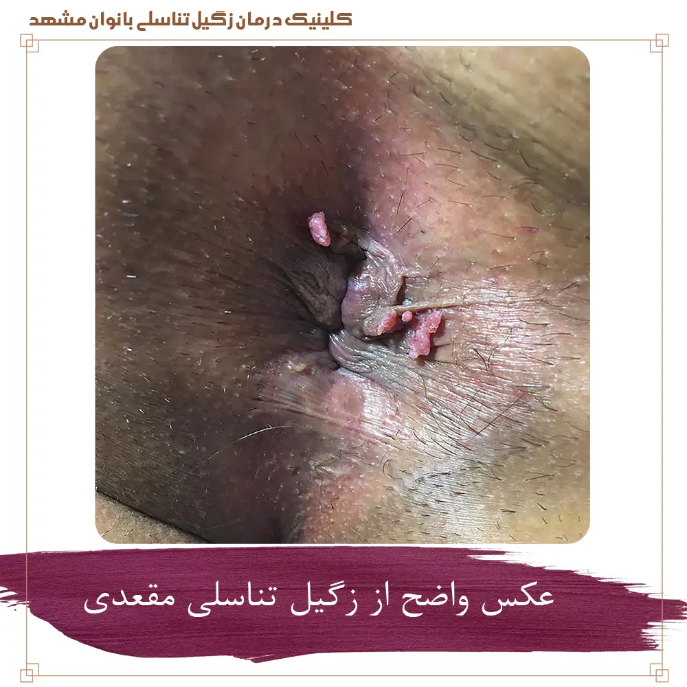 عکس واضح از زگیل تناسلی مقعدی