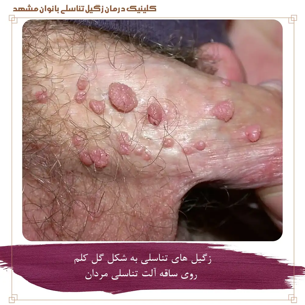 زگیل تناسلی به شکل گل کلم روی ساقه آلت تناسلی مردان