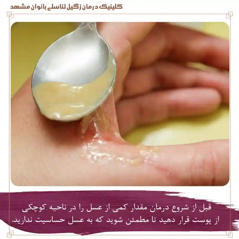تست حساسیت به عسل قبل از استفاده برای درمان زگیل تناسلی