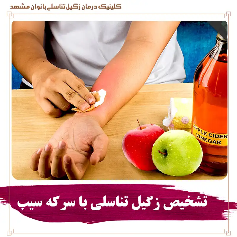 تشخیص زگیل با سرکه