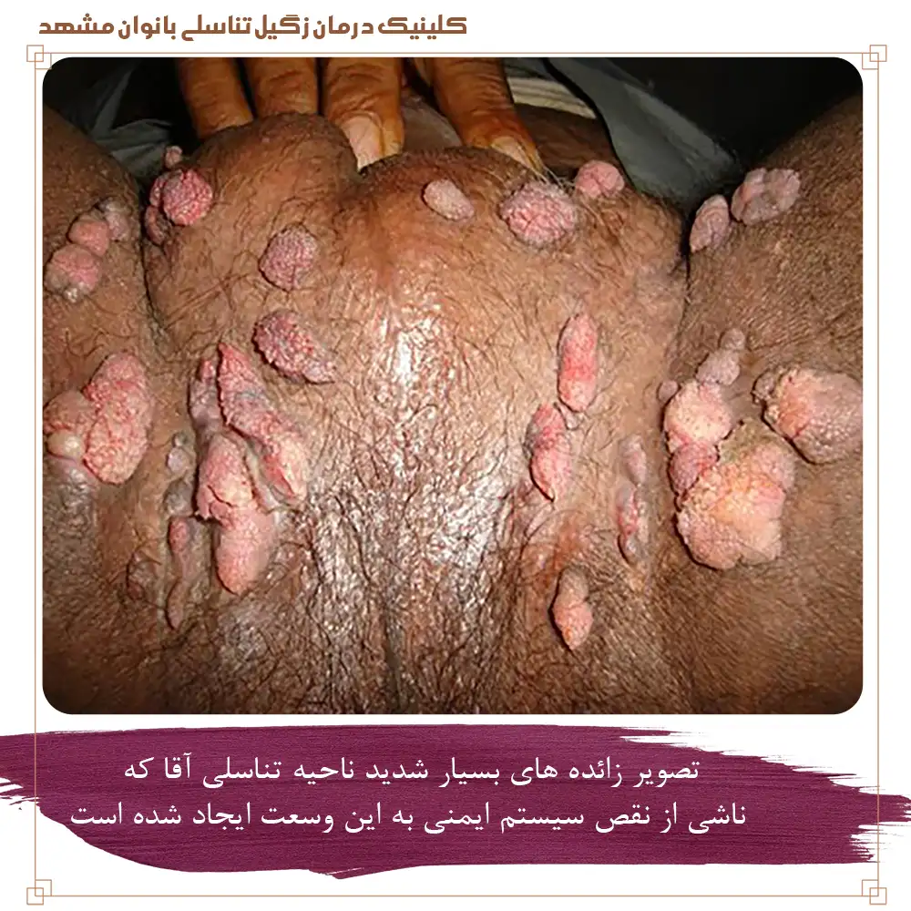 تصویر زائده های بسیار شدید ناحیه تناسلی مردان ناشی از نقص سیستم ایمنی