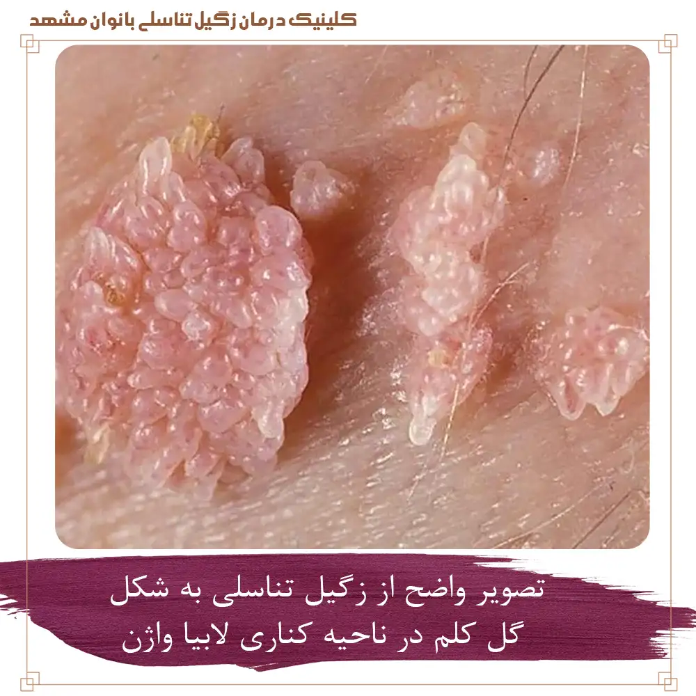 عکس واضح از زگیل تناسلی به شکل گل کلم در ناحیه کناری لابیا واژن