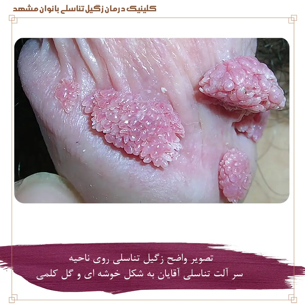 تصویر واضح زگیل تناسلی روی ناحیه سر آلت تناسلی آقایان به شکل خوشه ای و گل کلمی
