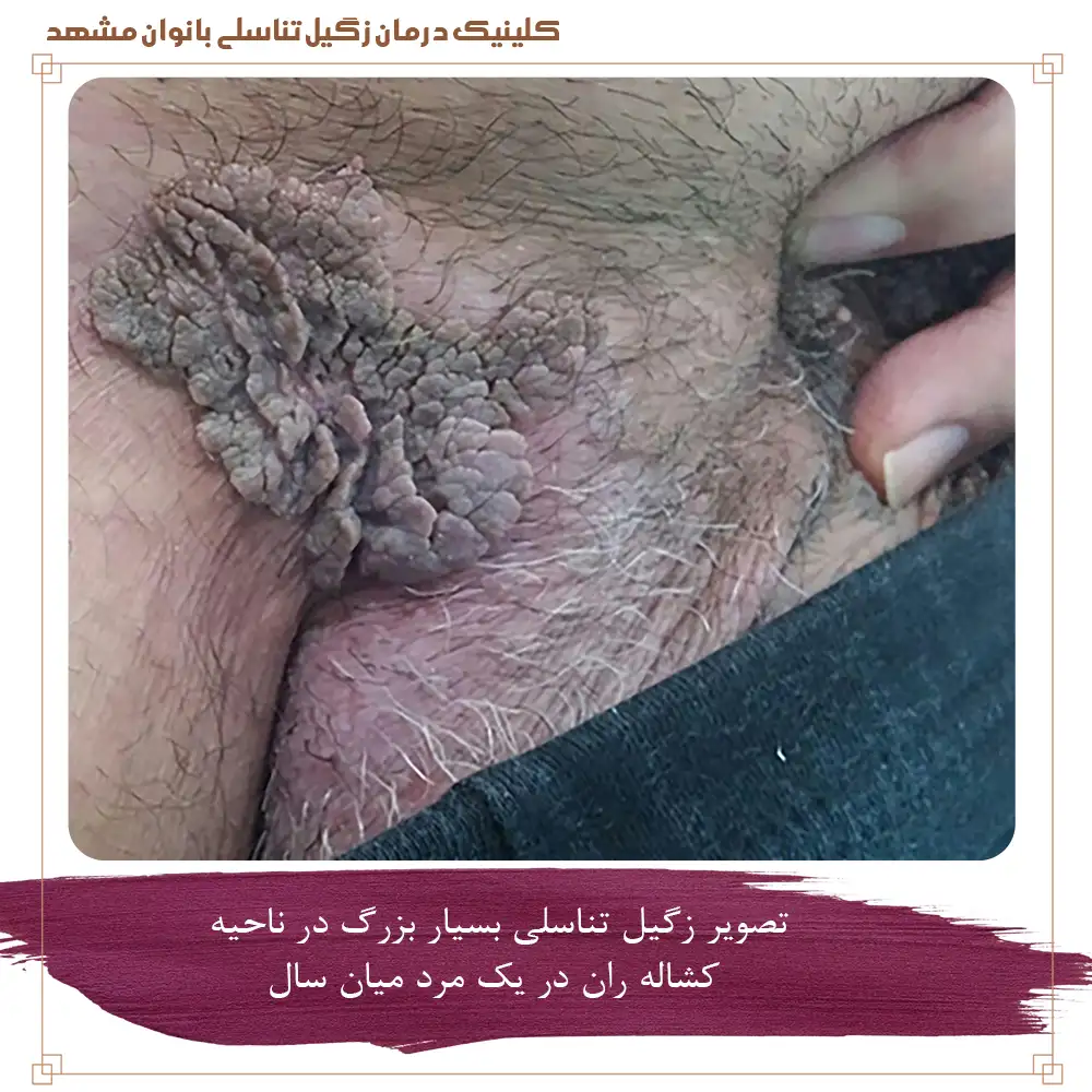 تصویر زگیل تناسلی بسیار بزرگ در ناحیه کشاله ران در یک مرد میان سال