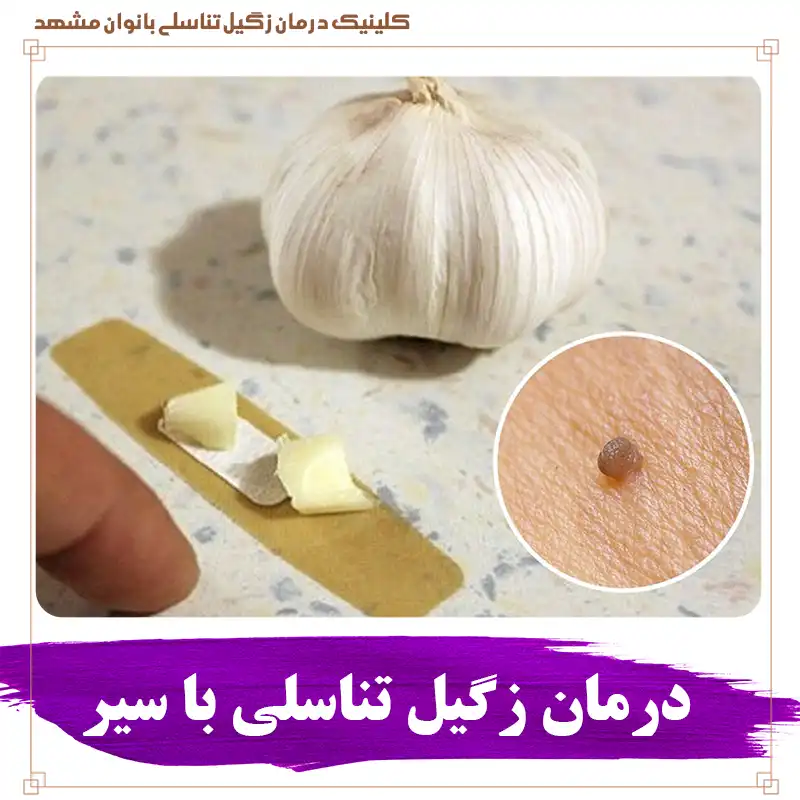 درمان زگیل تناسلی با سیر و سیر برای درمان اچ پی وی و نکات و یافته های علمی