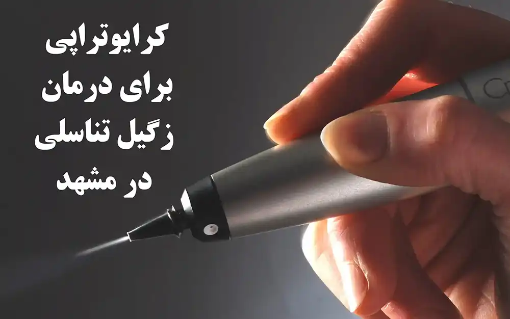 درمان زگیل تناسلی با کرایوتراپی در مشهد