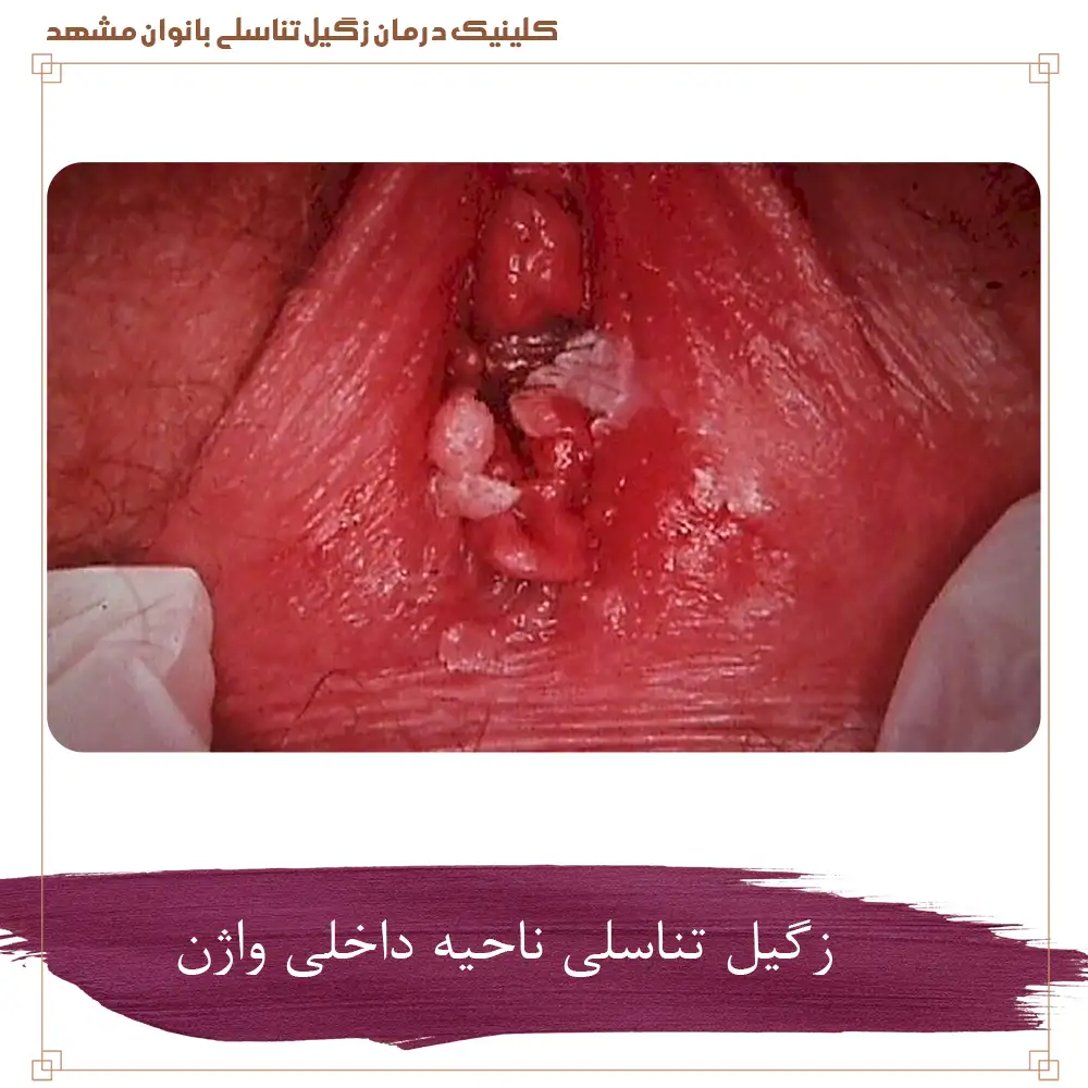 زگیل تناسلی ناحیه داخلی واژن